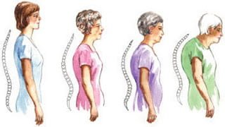 Bad posture: how to fix it and reduce back pain - Oryon