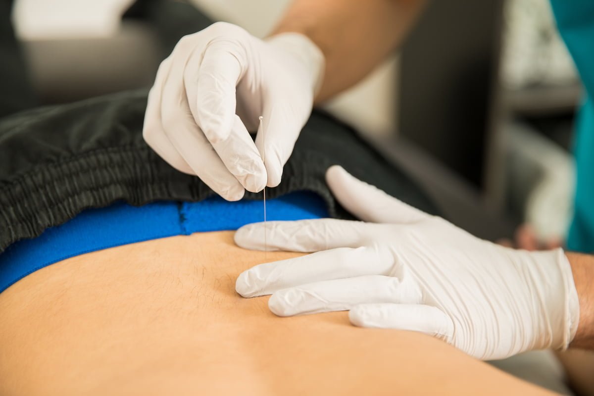 dry needling for pain
